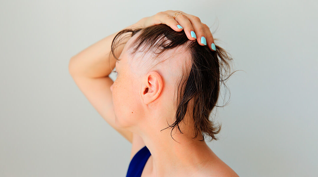 Alopecia Awareness Month