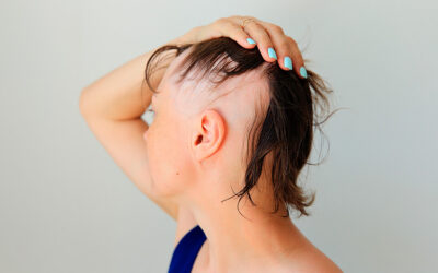 Alopecia Awareness Month